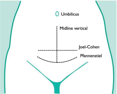 Caesarean Section Intechopen