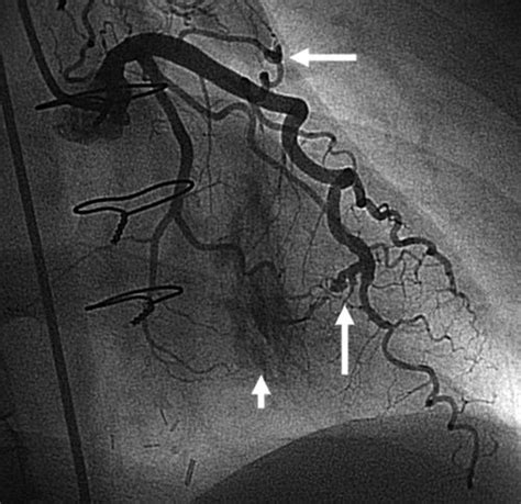 CoronaryCameral And Coronary Arteriovenous Fistulae In A Transplanted