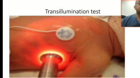 Transillumination Test For Pneumothorax Using Pigtails Catheter Youtube