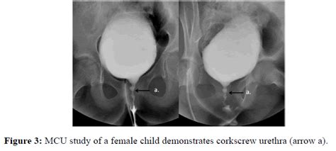 Spectrum Of Micturating Cystourethrogram Revisited A Pictorial Assay