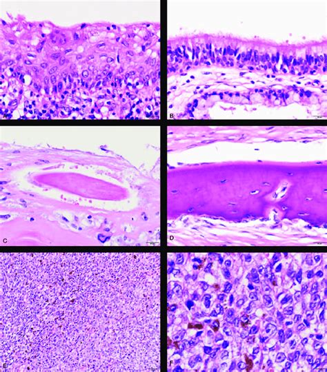 Histology Of Malignant Melanoma Arising In Ovarian Cystic Teratoma