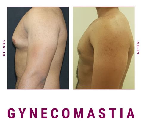 Male Breast Reduction Gynecomastia Before And After Results