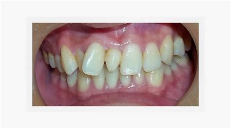 Mesiodens Extra Tooth Causes And Why It Should Be Treated