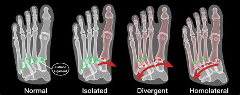 How Lisfranc Injuries Affect Fantasy Football Najee Bateman