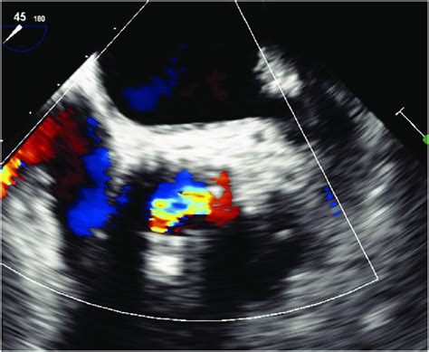 Preoperative Transesophageal Echocardiography Revealed Severe Ar And Download Scientific