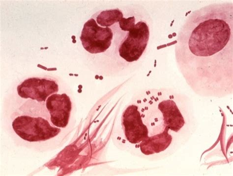 Gonorrhea Etiology And Symptoms Of The Gonococcal Urethritis