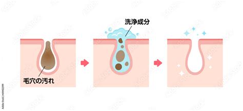 毛穴断面図イラスト 角栓・皮脂汚れの詰まった毛穴をクレンジングできれいにする様子 Stock ベクター Adobe Stock