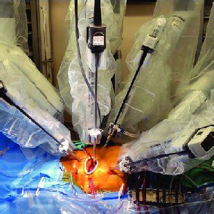 Standard Access And Port Placement For Robotic Mitral Valve Surgery