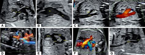 Frontiers Prenatal Echocardiography Diagnosis Of A Novel Combination