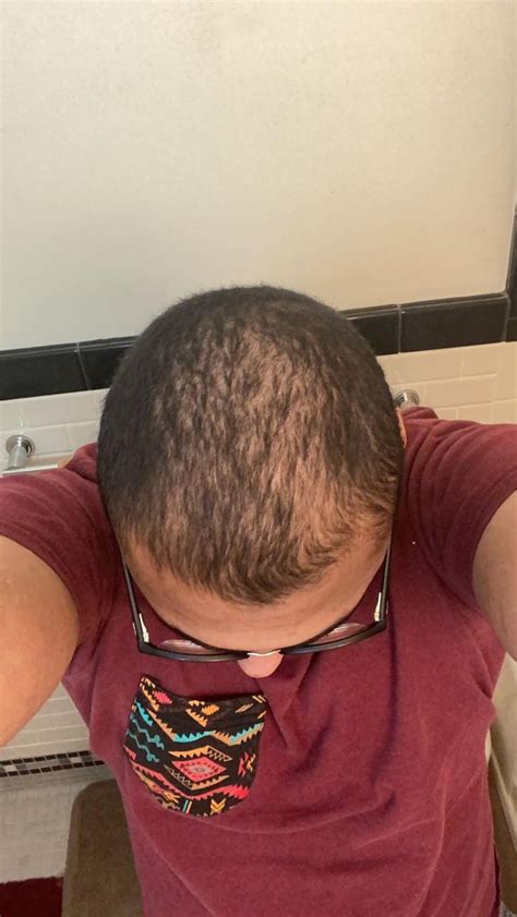 3 Years Of Finasteride And Minoxidil R Tressless