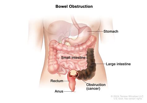 Definition Of Bowel Obstruction Nci Dictionary Of Cancer Terms Nci