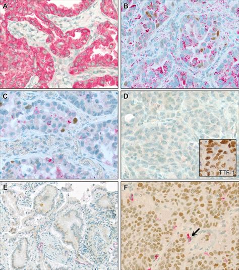 Napsin A P40 Antibody Cocktail For Subtyping Non‐small Cell Lung