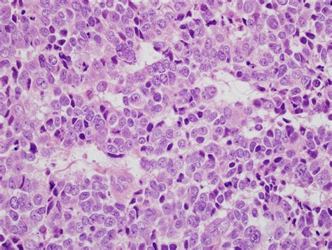 Pathology Outlines Large Cell Neuroendocrine Carcinoma