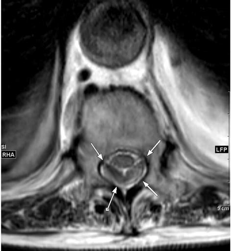 Subdural Spinal Haematoma After Epidural Anaesthesia Bmj Case Reports