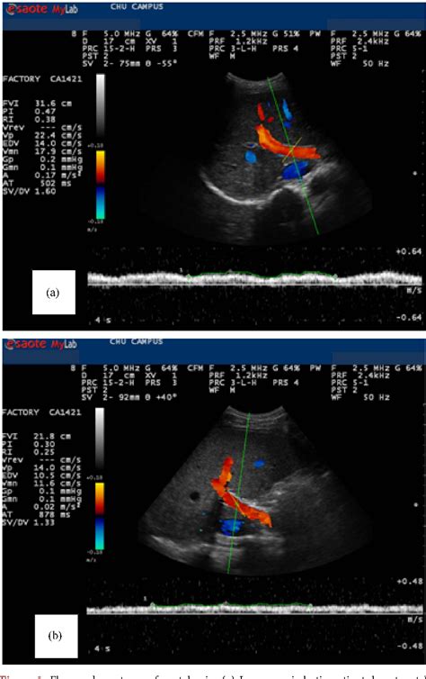 Left And Middle Hepatic Veins Ultrasound Medical Ultrasound Liver Hot Sex Picture