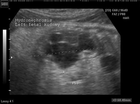 Fetal Hydronephrosis Ultrasound