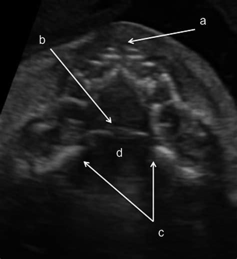 A Scorebased Method For Quality Control Of Fetal Hard Palate