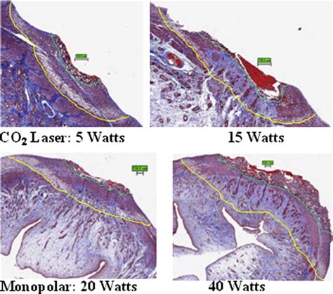 Greater Surgical Precision Of A Flexible Carbon Dioxide Laser Fiber