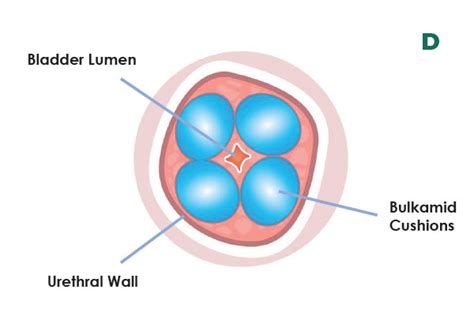 PURE Medical Device - Bulking Agent