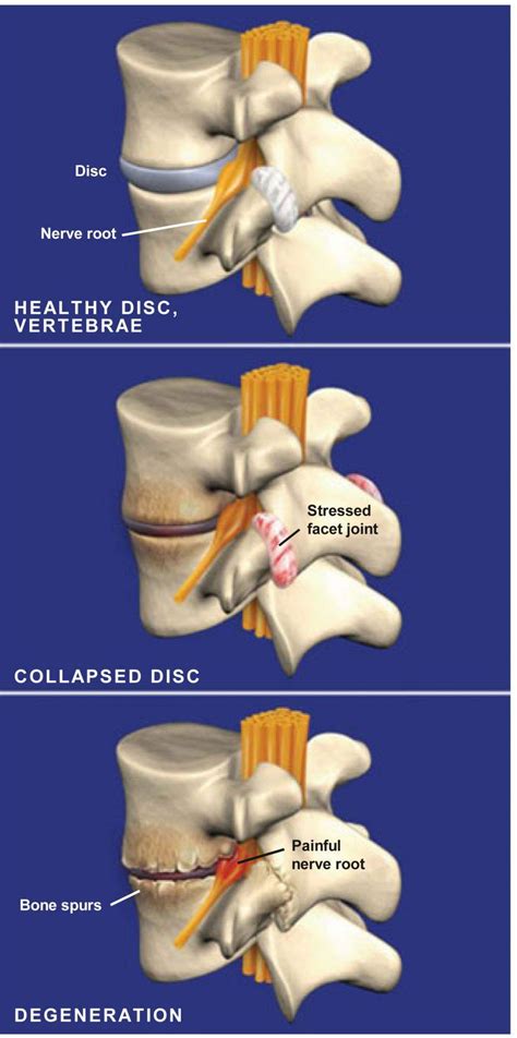 Spondylosis Treatment Plano Tx Advanced Spine Center