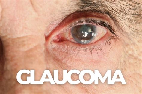 What Is The First Sign Of Glaucoma