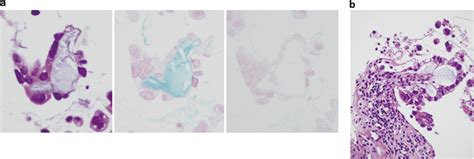 Alternate Mucoid And Hyalinized Stroma In Clear Cell Carcinoma Of The