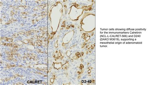 Pathology Outlines Adenomatoid Tumor