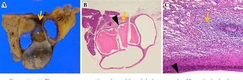 Figure 1 From Two Cases Of An Epidermoid Cyst Developing In An Intrapancreatic Accessory Spleen