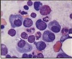 Células importantes en hematología LEUCEMIA DE CÉLULAS PLASMÁTICAS