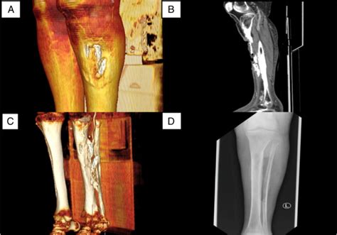 A Challenging Case Of Calcific Myonecrosis Of Tibialis Anterior And