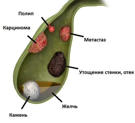 Полипы в желчном пузыре: что делать? | Nature Sunshine