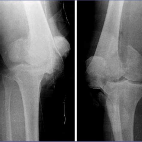 Case 1 Er X Rays Open 3b Fracture Of Distal Femur In 69 Year Old Woman Download Scientific