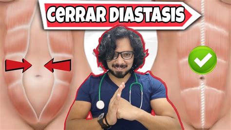 Diastasis Abdominal Que Es Y Como Tratarla Artofit