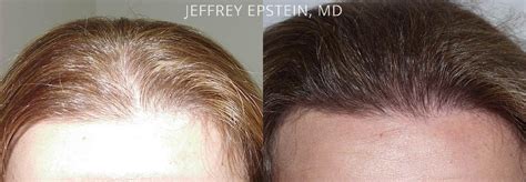 Hair Transplants for Women photos | Miami, FL | Patient41566