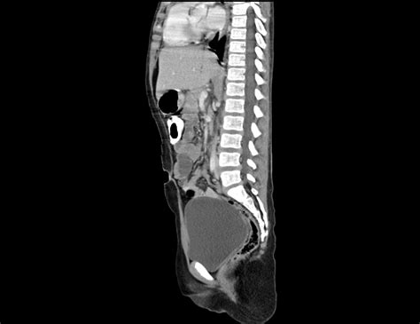 Tuberous Sclerosis Image