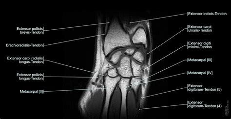 Wrist on 3T MR and 3D pictures: normal anatomy | e-Anatomy