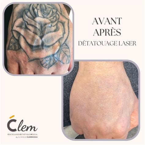 Laser détatouage Picosure CLEM