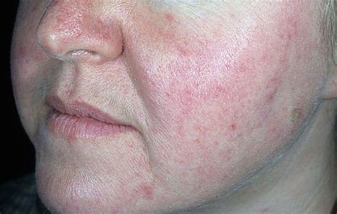 Rosacea Causes Symptoms Diagnosis Treatment And Prevention Diy