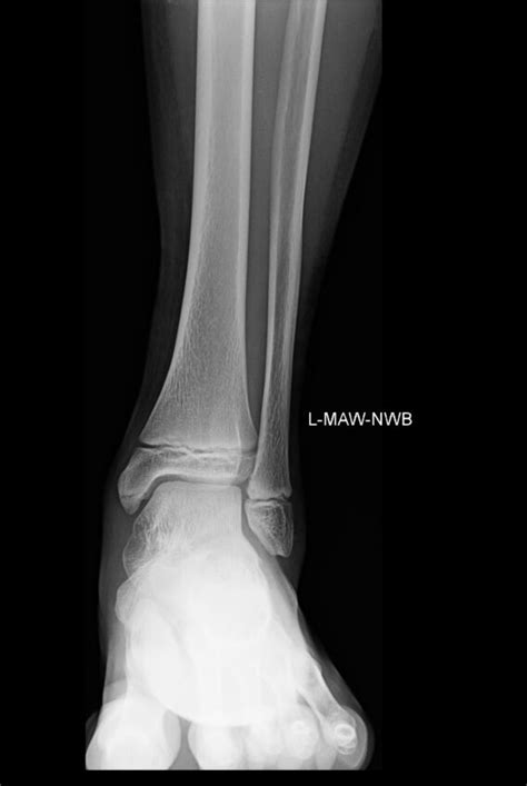 Orthodx Injury To Left Ankle Clinical Advisor