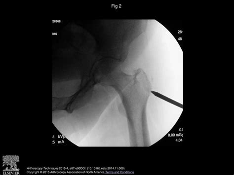 Trochanteric Micropuncture Treatment For Gluteus Medius Tendinopathy