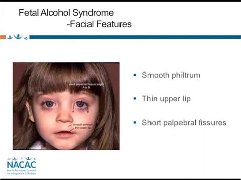 Fetal Alcohol Syndrome Facial Features