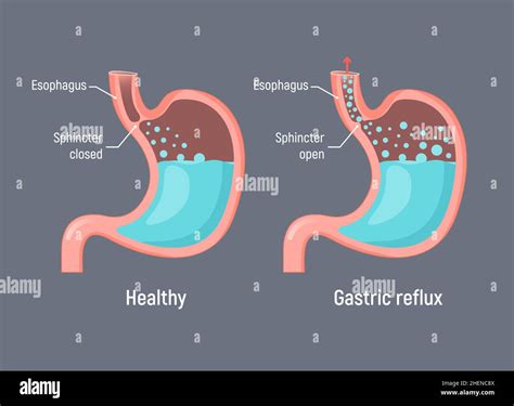 Indigestion De Lacide Gastrique De Reflux Gastriqueestomac Gastro