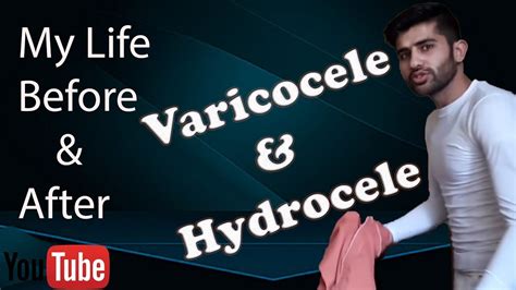 Varicocele Treatment My Story About Varicocele And Hydrocele After