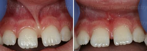 Labial Frenectomy Before And After