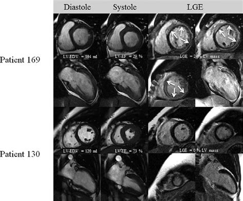 Typical Cardiac Magnetic Resonance Results Cardiovascular Magnetic