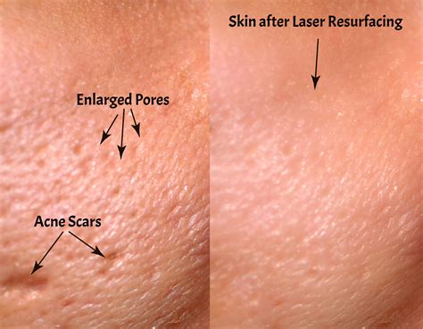 Ultra Fractional Co Pro Laser