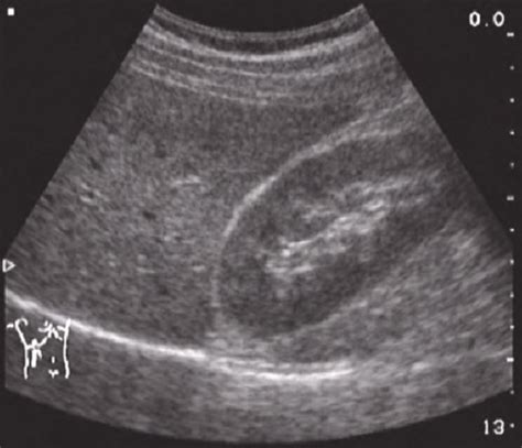 Liver Path Sonographic Findings Flashcards Quizlet