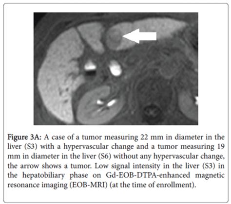 Liver Tumor Size Chart