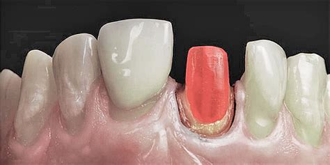 Reconstruction Of Endodontically Treated Teeth Dental Vip Posts