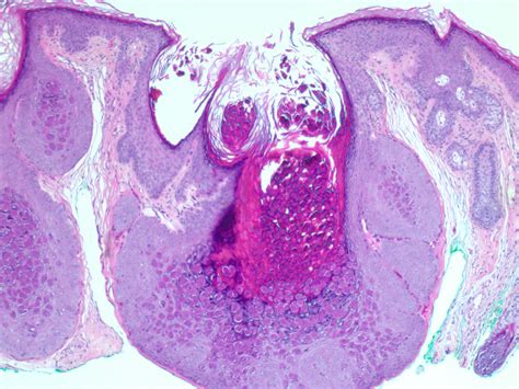 Molluscum Contagiosum White Core